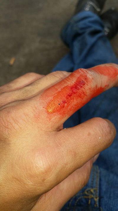 手指出血的图片